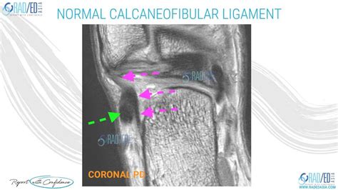 test for a calcaneal fibular ligament tear|torn calcaneofibular ligament symptoms.